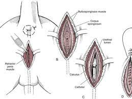 Urethra reroute
