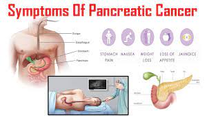The first stage in pancreatic cancer. Pancreatic Cancer Awareness Month Trustmedi