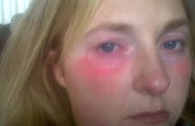 Rachel Warwick, la mujer alérgica al agua