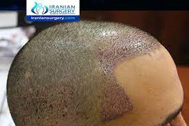 التهاب المنطقة المانحة بعد زراعة الشعر احمرار المنطقة المانحة بعد زراعة الشعر ایران سرجري