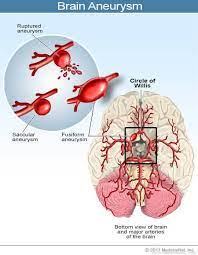 Brain Aneurysm Symptoms, Causes, Definition & Treatment