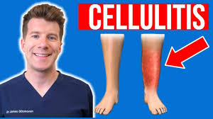 Image result for Cellulitis