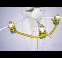 External Fixation Modular Rod System,Medical Device ...