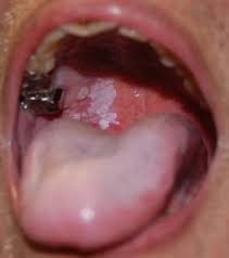 Image result for Erythroplakia roof of mouth