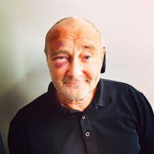 Oops! Phil said you should have seen the other guy! But unfortunately Phil  did take a fall