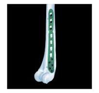 Distal Humeral Sub-condylar Locking Plate,Medical Device ...