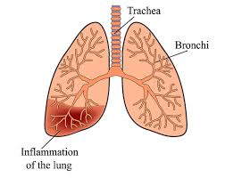 Image result for Pneumonia