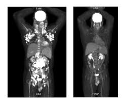 Patient Story: Adam Carty