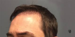 Ingrown hairs might happen but should resolve on their own in time. Why Does Donor Hair Continue To Grow After Hair Transplant Surgery Ahs India