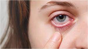 Maybe you would like to learn more about one of these? What Are First Symptoms Of Black Fungus Due To Covid 19 Doctors Explain What News India Tv