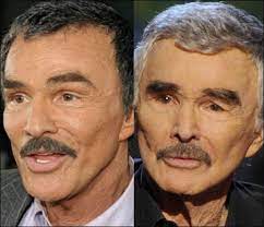 Celebrities have never been afraid to jump on the plastic surgery bandwagon. Burt Reynolds Plastische Chirurgie Und Kosmetische Veranderungen Chirurgie Kosmetische Plast Plastic Surgery Celebrity Plastic Surgery Plastic Surgery Fail