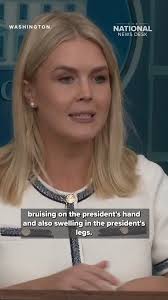 President Donald Trump's doctor confirmed good health despite swelling in  the president’s lower legs and bruising