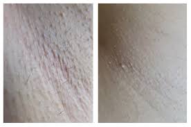 Quel que soit votre type de peau lazeo possède les meilleures technologies pour éliminer définitivement vos poils. Mon Epilation Definitive Ipl Chez Depil Tech What What
