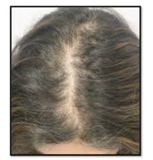 Don't let thinning hair cramp your style! Female Pattern Hair Loss Canadian Hair Loss Foundation