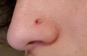 Is This A Granuloma If So How Do I Get Rid Of It I Ve Only Had My Piercing For About A Month And A Half And This Popped Up 3 Days Ago