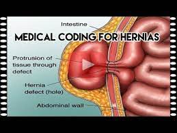 A surgical procedure in which an incision, or cut, is made in the groin. Medical Coding For Hernias Medical Coding Training Youtube