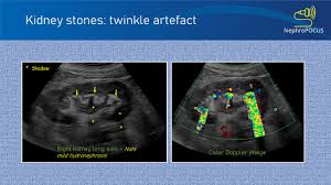 Image result for Nephrolithiasis Imaging