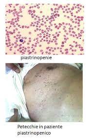 Distruzione periferica e ridotta produzione. Trombocitopenia O Piatrinopenia Classificazione