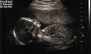 Ssw an, in einigen häusern ist auch ein organscreening zwischen der 22. Ultraschall In Der 18 Bis 22 Ssw Netdoktor At