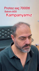 Alper Aslan Protez Saç