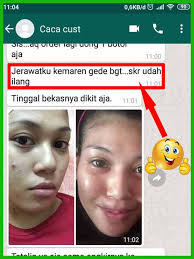 Perbedaan Manfaat Acnes Sealing Gel Dan Spot Care Obat Jerawat