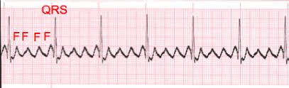 Image result for Atrial Flutter