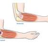 Inflammation of the tendon causes pain when the muscle is stretched or contracted, and when the treatment of lower leg pain. 1