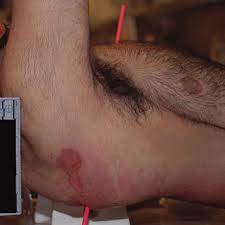 Practical pathology of gunshot wounds j. Https Www Ajronline Org Doi Pdfplus 10 2214 Ajr 07 2754
