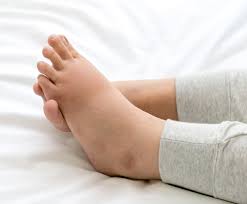 Que, cuando ejerce función de pronombre relativo o conjunción, se escribe sin tilde, debido a que se trata de una palabra átona. Por Que Se Hinchan Los Pies Causas Y Recomendaciones Para Evitar Los Pies Hinchados Podoactiva Lideres En Podologia