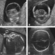 The healthcare provider may also take a blood sample. Ultrasound Features In Trisomy 13 Patau Syndrome And Trisomy 18 Edwards Syndrome In A Consecutive Series Of 47 Cases Abstract Europe Pmc