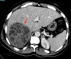 Image result for Liver Abscess
