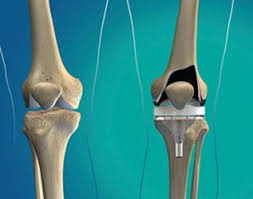 Total Knee Replacement Surgery Cost In Mumbai View Cost Contact Details Call 02225690799 093 Total Knee Replacement Knee Replacement Surgery Knee Replacement