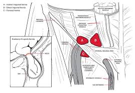 Aetiology And Prevalence Of Inguinal Hernia A Hernia Is A Condition When An Organ Or A Part Of A Tissue Mu Laser Clinics Hernia Symptoms General Practitioner