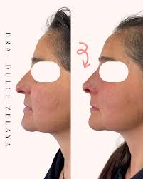 Rinomodelación con ácido hialurónico 💉 Mejora el perfil y armoniza el  rostro ✨ . #rinomodelacion #ácidohialuronico #medicinaestetica  #liquidrhinoplasty