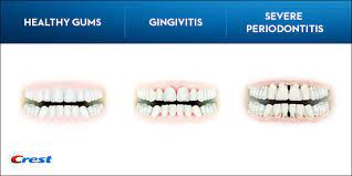 Gingivitis is a common and mild form of gum disease (periodontal disease) that causes irritation, redness and swelling (inflammation) of your gingiva, the part of your gum around the base of your teeth. What Is Gingivitis Symptoms Causes And Treatments Crest