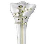Advanced Nailing System | DePuy Synthes