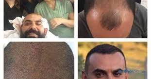 Dunya Sac Ekim Danismanligi Dunya Sac Ekim Danismanligi Turkiye De Sac Ekim Merkezleri Mersin Sac Ekim Mersinde Sac Ekim Merkezleri Mersi Sac Ince Saclar Dunya