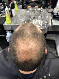 Buzz cut for thinning hair. Are You Suffering From Thinning Hair Iconic