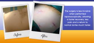 They may be advised to avoid heavy lifting or strenuous activities for about six weeks. Hernia Recovery Hernia Repair Centre Gold Coast Brisbane