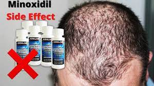 Minoxidil's side effects are typically mild. Watch Before Using Minoxidil Side Effects Minoxidil à¦ª à¦° à¦¶ à¦¬ à¦ª à¦°à¦¤ à¦• à¦° à¦¯ Youtube