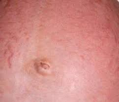 Image result for pruritic urticarial papules and plaques of pregnancy