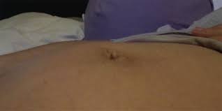 Please keep reposting to a minnimum. Pregnant Woman S Belly Button Trick Turns Out To Be An Umbilical Hernia