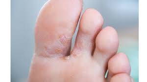 Memaksa memasukkan kaki hingga hujung jari sempit; Kulit Di Sela Jari Kaki Bersisik Alergi Atau Kutu Air