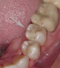 How long can i wait to treat a cavity? A Comparison Of Dental Filling Materials Portland Or Dr Martha Rich Dmd A Comparison Of Dental Filling Materials Dentist Portland Or