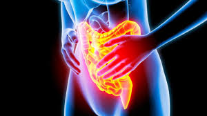La rettocolite ulcerosa è una malattia infiammatoria cronica intestinale che coinvolge selettivamente la mucosa del retto e/o del colon, nella maggioranza dei casi la parte discendente. Consigli Rimedi E Diete Per Chi Soffre Di Colite Ulcerosa 100salute