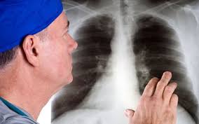 The chance of getting prostate cancer goes up as a man gets older. Lung Cancer In Males Signs Symptoms Complications