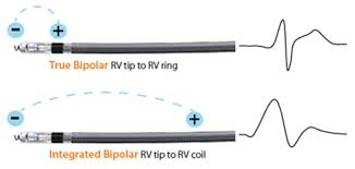 The lead that sees the current makes the wave. Rv Sense Polarity Feature Medtronic Academy