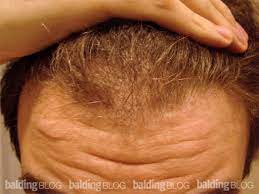 But does anything actually work? 24 Year Old Has Hair Loss After Losing Weight With Photos Wrassman M D Baldingblog