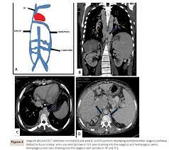 Collateral Pathways In Budd Chiari Syndrome Mdct Depiction Insight Medical Publishing