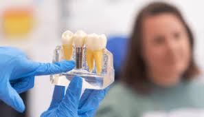 Implantes dentales en Cajamarca